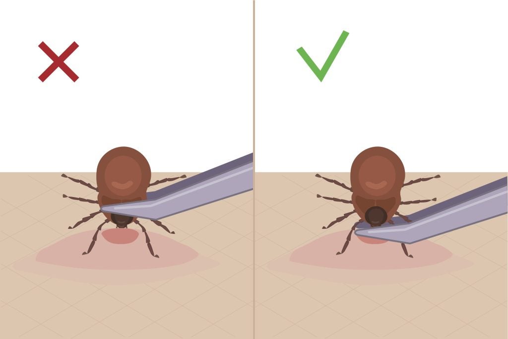 How to avoid ticks how to remove a tick safely